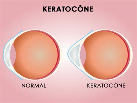 Kératocône Cabinet Foch Ophtalmologie à Nice