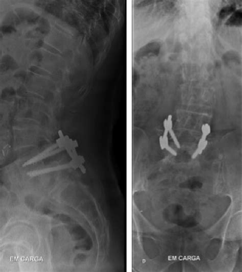 Instrumenta O De Uma Espondilolistesis L L Atraves Da Aplica O De