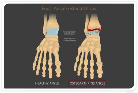 Regenerative Medicine For Ankle Arthritis And Tendonitis Stemx