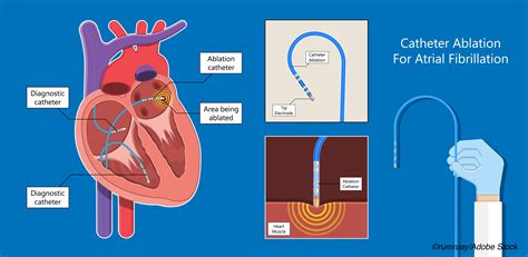 Catheter Ablation May Be Better Option For Non White Afib Patients Physicians Weekly