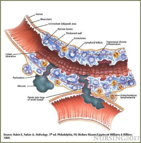 Pathophysiology And Clinical Presentation Crohn S Disease