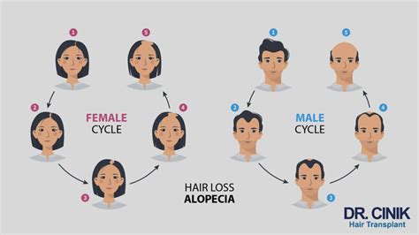 Comparing FUE Variants: Traditional vs. Sapphire vs. DHI vs. Manual vs ...