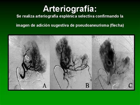 Caso 3 Pseudoaneurisma De Arteria Esplnica Distal Mujer