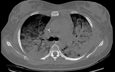 Reporte de un caso neumonia por lophomonas Actualidad Médica