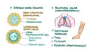 Granuloma Fibrosis