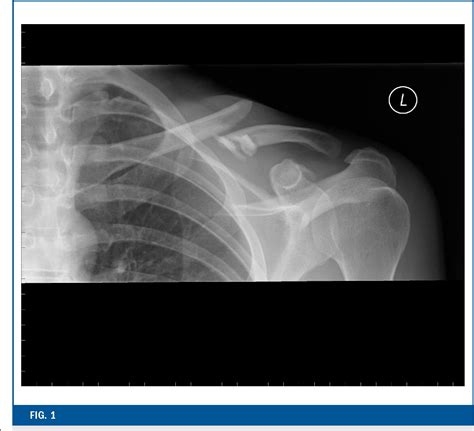 Figure 1 From Midshaft Clavicular Fractures Surgical Technique