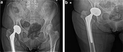 Intraprosthetic Dislocation Of A Modular Dual Mobility Total Hip Arthroplasty With Posterior