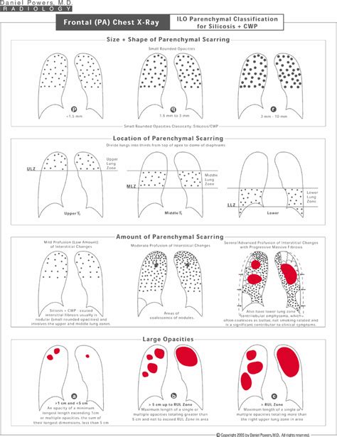 Silicosis Diagrams