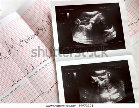 Ultrasound Portrait Fetus Cardiogram Results Stock Photo (Edit Now) 69973321