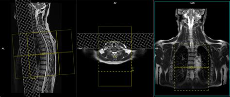 Normal Thoracic Spine Mri