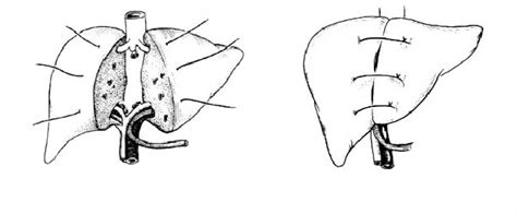 肝叶切除术图解 手术图解医学图库
