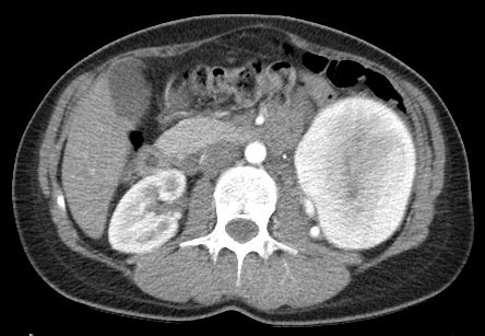 Visceral Embolization Case Albany Ir