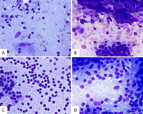 A A Peculiar Case Of Seminoma Almost Devoid Of Neoplastic Cells Only