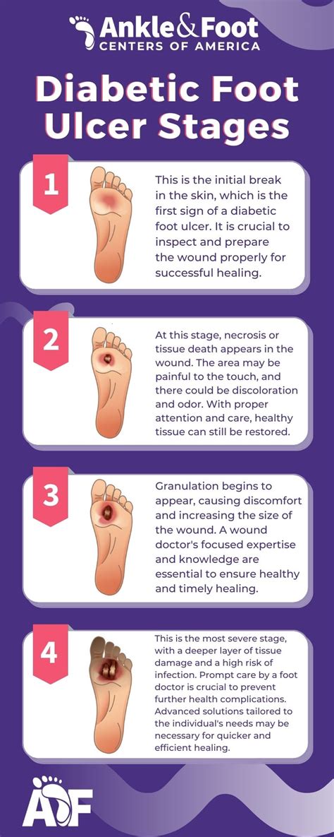 Diabetic Foot Ulcer Stages Atlanta Wound Doctor Explains