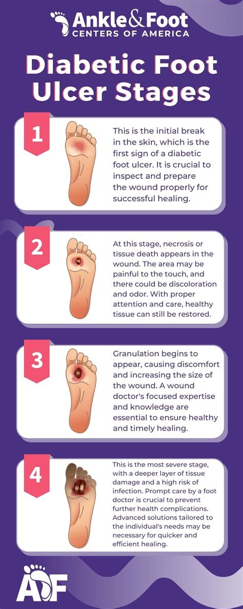 Diabetic Foot Ulcer Treatment & Prevention - What to Know!