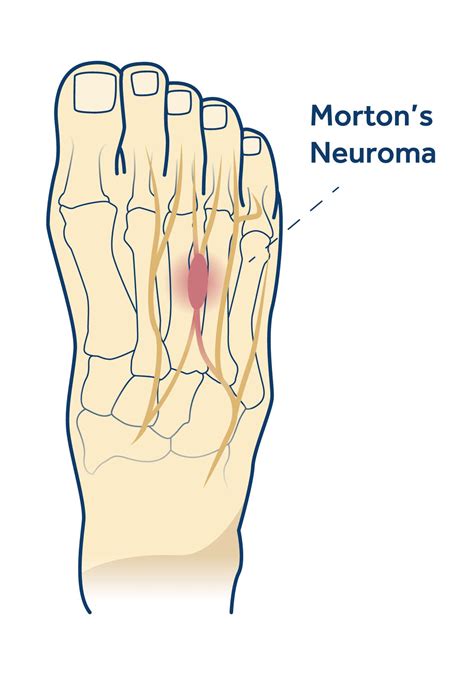 Mortons Neuroma Erko Podiatry Your Local Podiatrists