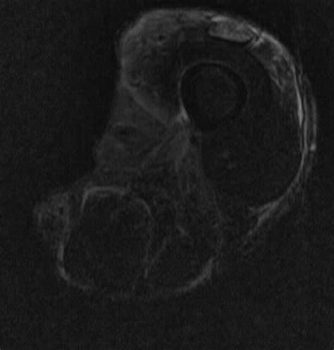 Marjolin Ulcer - Sumer's Radiology Blog