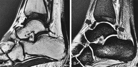 Arthritis And Cartilage Radiology Key