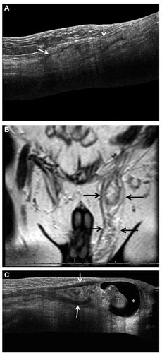 Imaging Features Of Paratesticular Masses Secil 2017 Journal Of