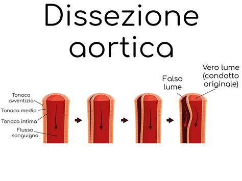 Dissezione Aortica Cause Sintomi Pericoli E Cura