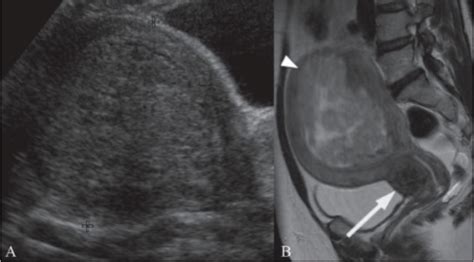 Leiomiomas Y Leiomiosarcomas Uterinos Concise Medical Knowledge