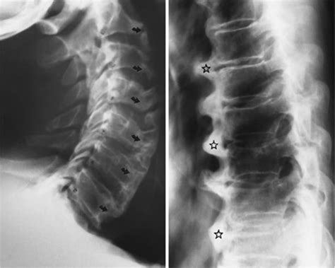 Anterior Longitudinal Ligament Cervical Spine