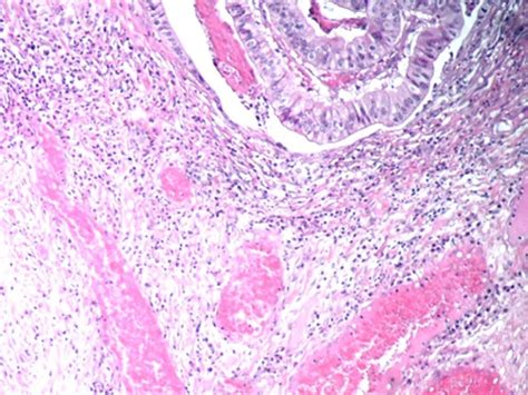 Tumoral Stroma With Moderate Chronic Inflammatory Vascular Congestion