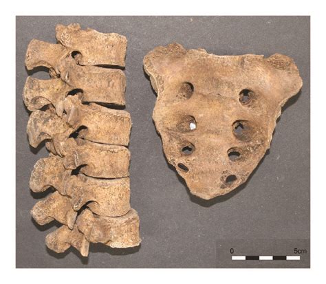 Extra Sixth Lumbar Vertebra Left With Normal Sacrum Consisting Of 5