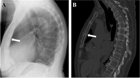 Sternal Fracture X Ray