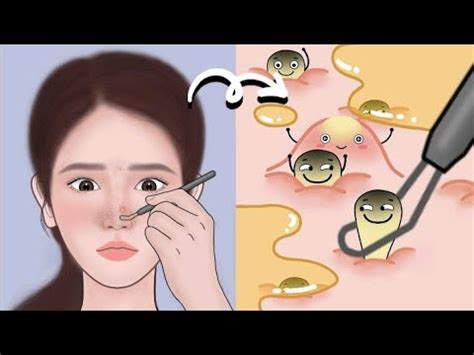 Asmr Acne Removal Skin Care Animation Full Blackhead Treatment Nose