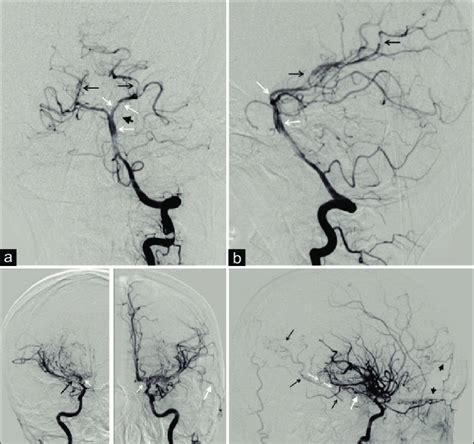 A B Dsa Of Left Vertebral Artery Va Dissection Of Ba With Flap