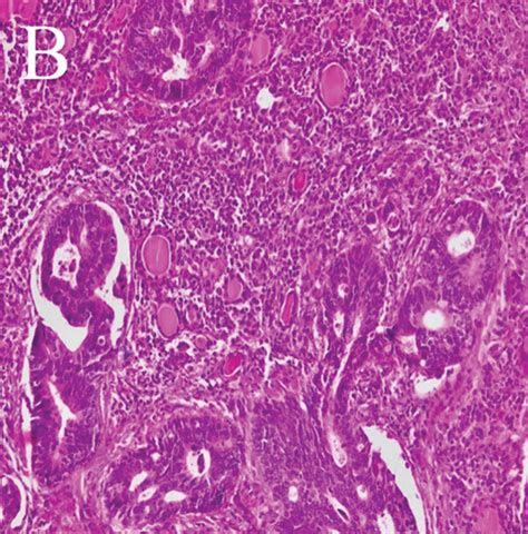 Microscopic Sections Show Metastatic Glands Of Colon Adenocarcinoma Download Scientific