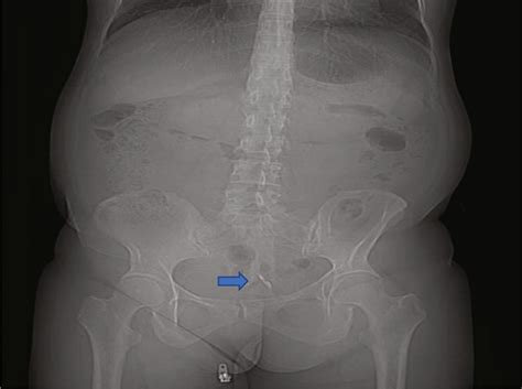 Woman's IUD 'eroded' through her uterus and punctured her bladder ...