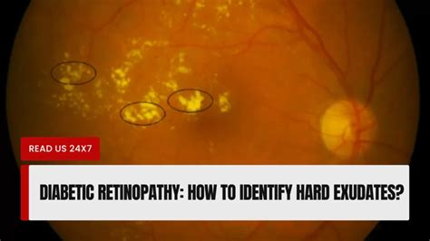 Diabetic Retinopathy: How to Identify Hard Exudates?