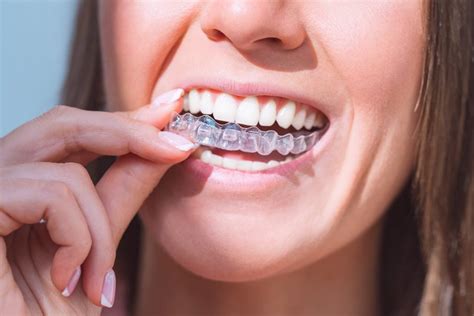 Types Of Braces Procedures Costs Faqs