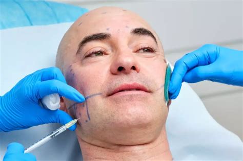 Marcaci N Mandibular Con Cido Hialur Nico En Hombres