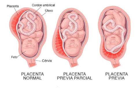 Placenta Previa en el Embarazo Intituto Dra Gómez Roig