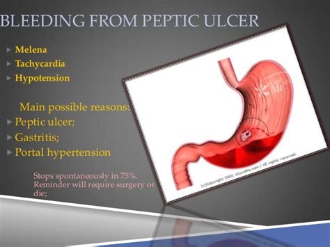 Peptic Ulcer Complications