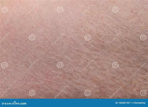 Texture of Human`s Skin with the Scar Burn, Closeup Photo Stock Image ...