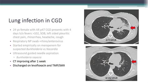 Granuloma Lung Disease