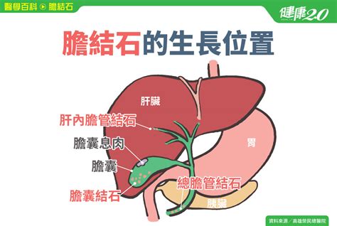 膽結石／膽結石和膽固醇有關！膽結石會有什麼症狀？腹痛嚴重小心敗血症成因危險因子種類