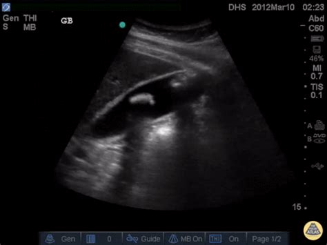 Gallstones Differential Diagnosis Of