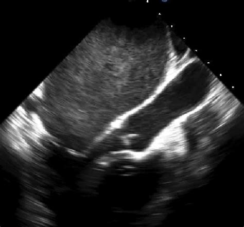 Left Atrial Spontaneous Echo Contrast Sec Rk Md