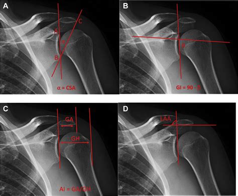 Radiographic Measurements Of Selected Anatomic Shoulder Parameters