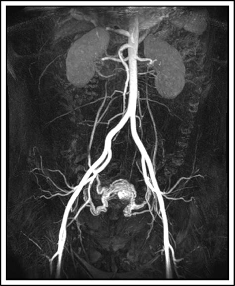 Malformation Artérioveineuse Utérine Journal Of Obstetrics And