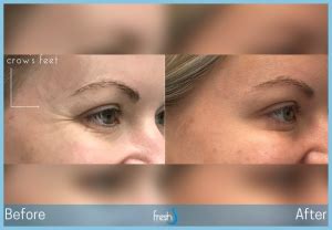 Cosmetic Injectables Nw Calgary Fresh Laser Skin Studio