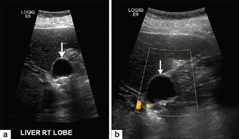 Pdf Cystic Duct Remnant Syndrome Semantic Scholar