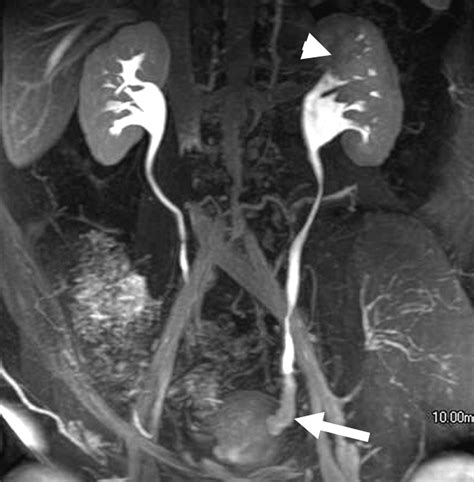 Mr Urography Techniques And Clinical Applications Radiographics