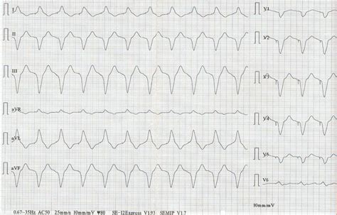 12 lead ECG after temporary ventricular pacing, depicting ventricular ...