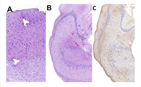 Histopathology Of The Resected Cortex A And Hippocampus B C